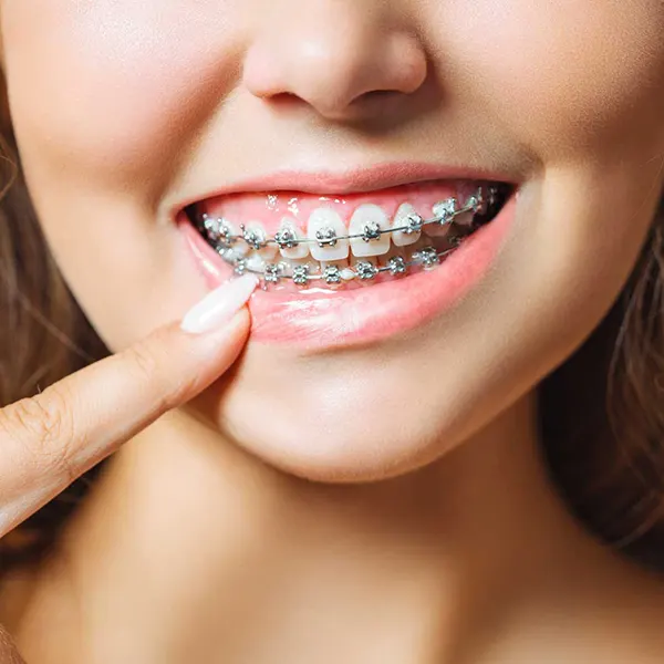 Brackets Metalicos