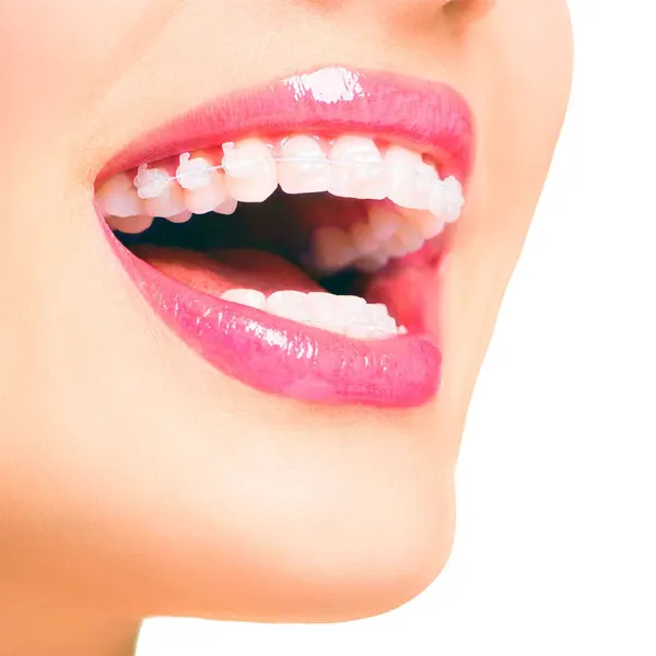 Brackets Zafiro