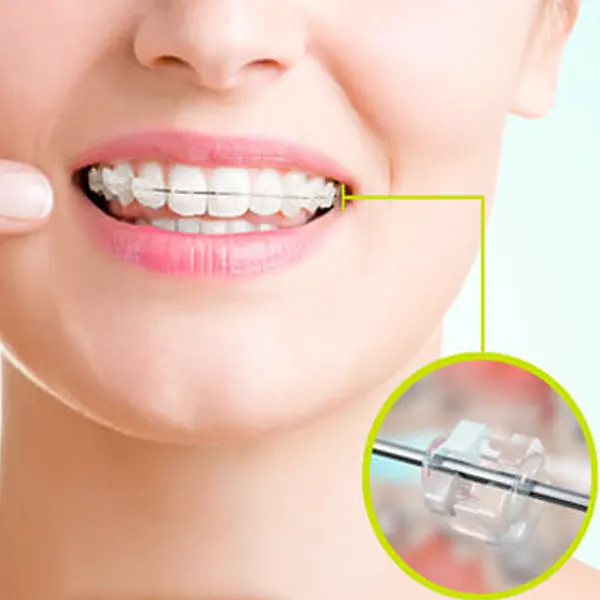 Brackets Ceramico