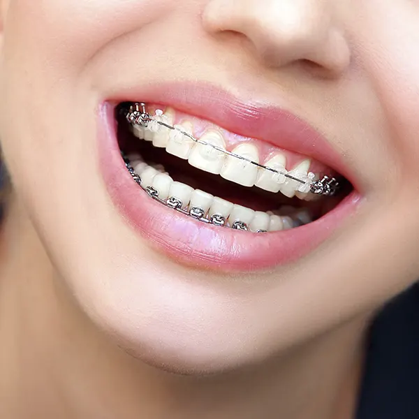 Brackets Autoligado