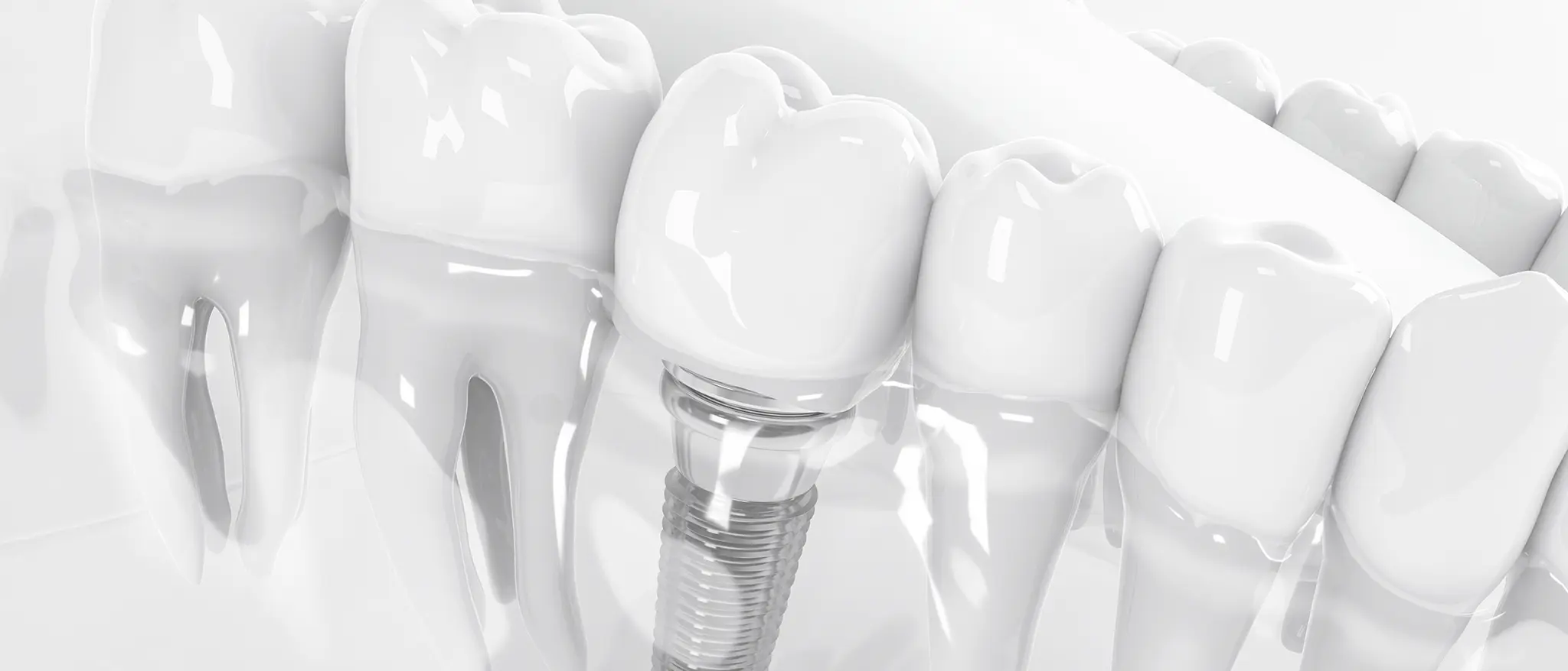 Implantes dentales